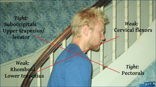 eirik-garnas-upper-crossed-syndrome-2